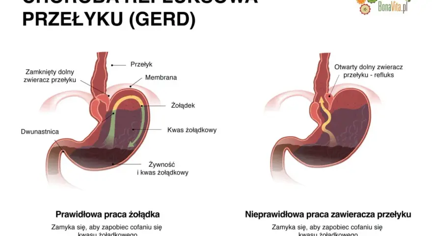 Ilustracja pokazuje, jak wyleczyłem refluks: prawidłowe zamknięcie zwieracza przełyku zapobiega cofaniu się kwasu żołądkowego.